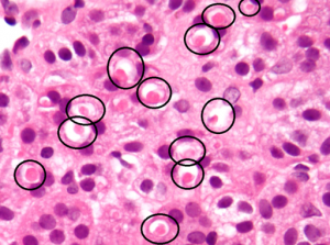 Spironolactone_bodies